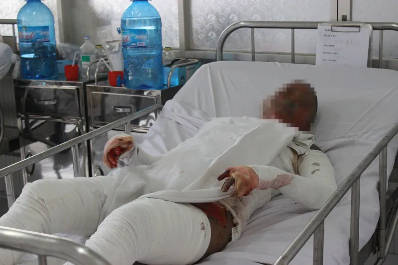 Cô gái bị bỏng nhảy từ lầu 1 xuống đất đang nguy kịch ảnh 1 Cô gái bị bỏng nhảy từ lầu 1 xuống đất đang nguy kịch ảnh 1