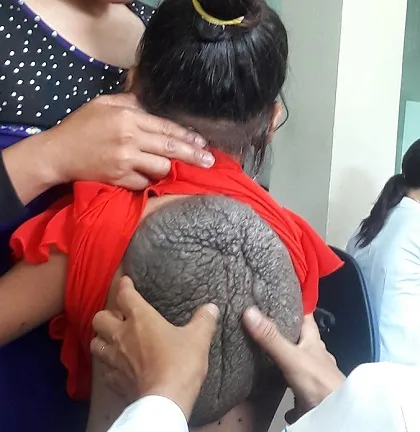 Cô bé “mai rùa” xuất viện khỏe mạnh ảnh 2 Cô bé “mai rùa” xuất viện khỏe mạnh ảnh 2