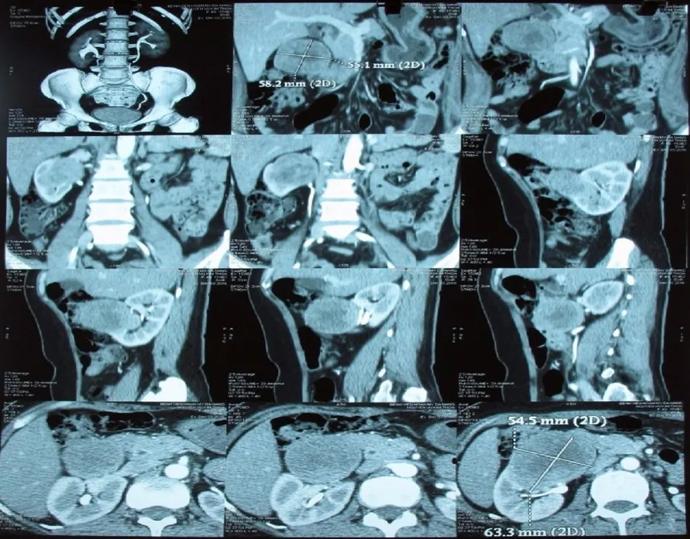 90% u ở thận là ung thư ảnh 1 Những khối u thận thường làm các bạn trẻ chủ quan