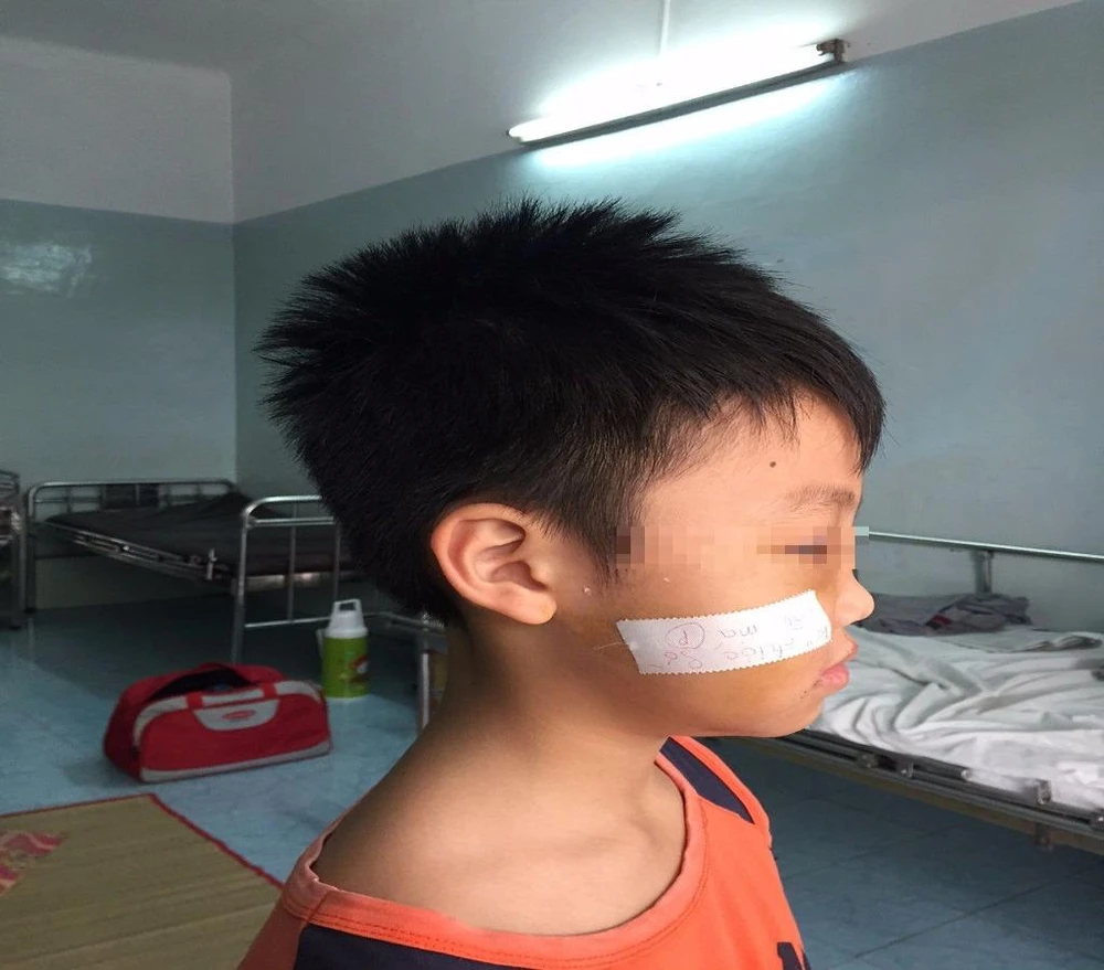 bé bị gãy xương gò má