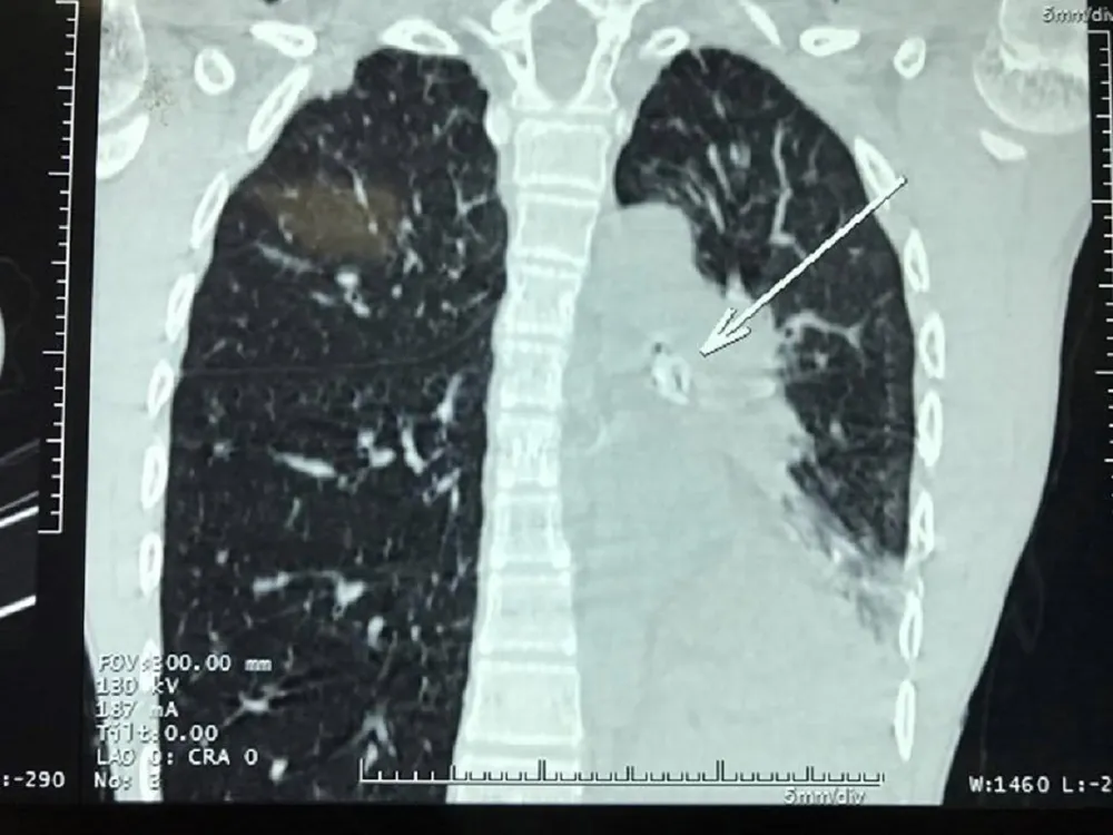 Bé trai suýt chết vì hạt xí muội lọt vào phế quản ảnh 1