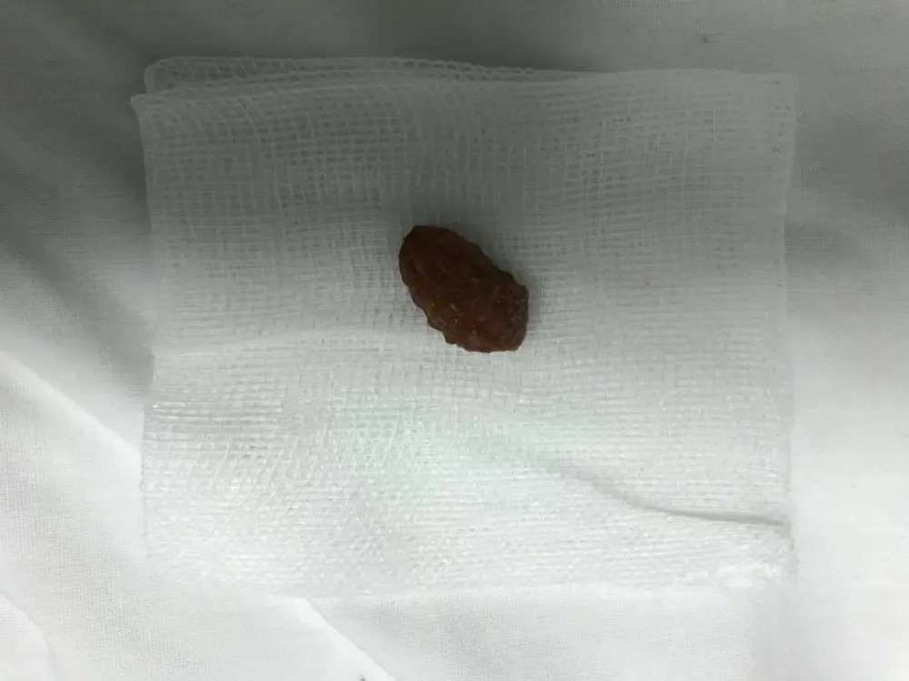 Bé trai suýt chết vì hạt xí muội lọt vào phế quản ảnh 2