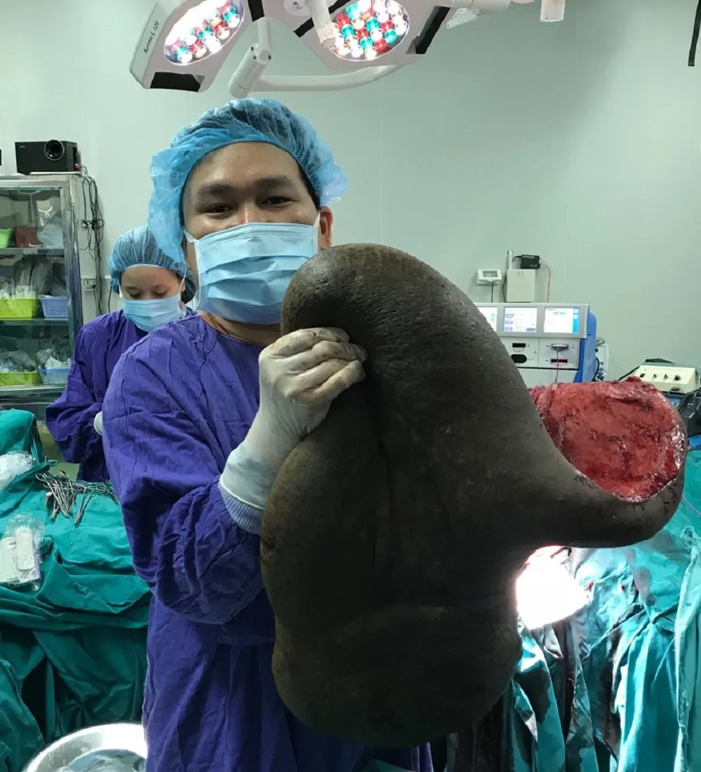 Kỳ lạ chàng trai mang 'mai rùa' nặng 15 kg suốt 26 năm ảnh 2 Kỳ lạ chàng trai mang 'mai rùa' nặng 15 kg suốt 26 năm ảnh 2