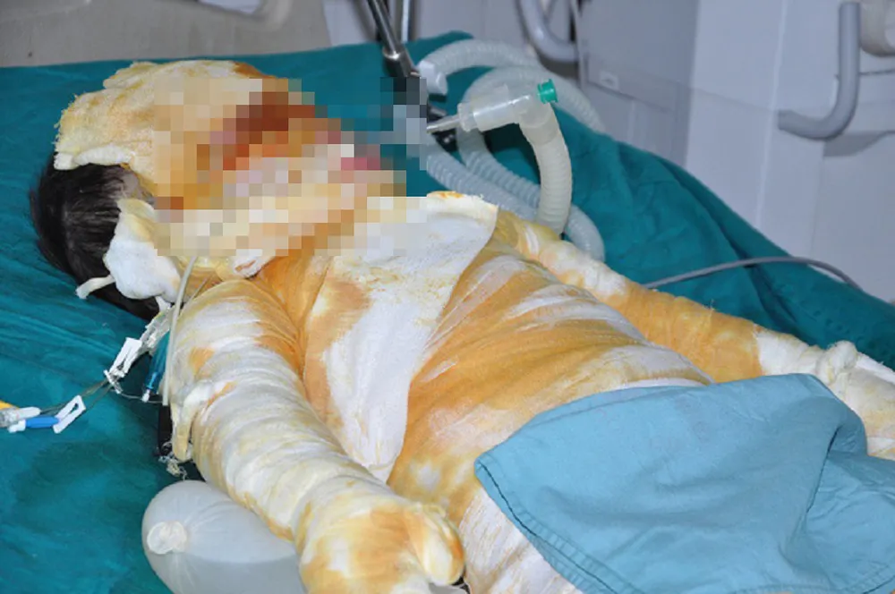 Cháy nhà không rõ nguyên nhân, bé 4 tuổi bỏng nặng ảnh 1