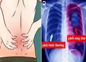Ðau lưng phía sau phổi có phải dấu hiệu ung thư?