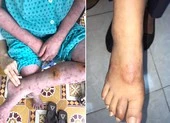 Xét nghiệm COVID-19 các thực phẩm đông lạnh từ nước có dịch ảnh 2 Coi chừng nhầm lẫn bệnh phong với viêm da