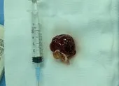 Thử nghiệm vaccine COVID-19 thứ 2 do Việt Nam sản xuất ảnh 3 4 giờ phẫu thuật cứu người phụ nữ mang khối u trong tim