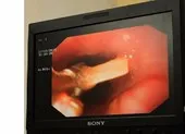 Cắt nửa lá phổi vì hóc xương cá 5 năm trước ảnh 3 Xém chết vì hóc xương rồi ngồi đợi xương... tự tan