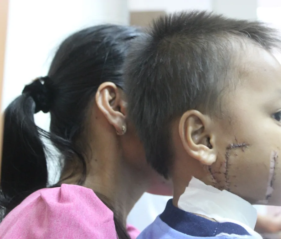 Kinh hoàng bé trai bị cánh quạt công nghiệp cắt thấu xương hàm ảnh 1 Kinh hoàng bé trai bị cánh quạt công nghiệp cắt thấu xương hàm ảnh 1