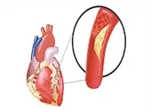 50% người bị tăng huyết áp không biết mình mắc bệnh ảnh 3 Ai dễ mắc máu nhiễm mỡ?