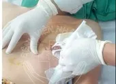 Đi cắt lúa thuê, bé trai nhà nghèo bị thanh sắt đâm thấu ngực ảnh 4 Té ngã, bị dao gọt trái cây đâm thấu tim