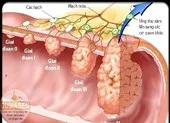 6 triệu chứng thầm lặng của ung thư đại tràng
