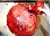 Tự uống thuốc, để khối u xơ nặng tới 4kg