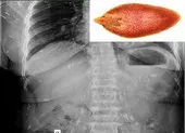 Đau thắt lưng, đi khám ra sán lá gan lớn sinh sôi khắp cơ thể 