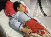 Bé trai 10 tuổi hoại tử ruột vì nuốt 9 viên bi nam châm
