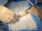 Học theo phim, bé trai nhét cây thông cống dài nửa mét vào hậu môn ảnh 2 Bác sĩ dùng màng ngoài tim bò tạo đoạn động mạch chủ bụng bị hư cứu bệnh nhân