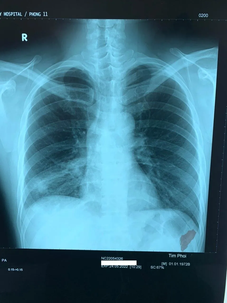 Kết quả chụp CT cho thấy mảnh xương nằm trong phổi. Ảnh: BVCC Kết quả chụp CT cho thấy mảnh xương nằm trong phổi. Ảnh: BVCC
