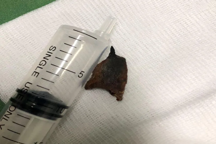 Mảnh xương heo nằm trong phổi bệnh nhân đã 20 năm. Ảnh: BVCC Mảnh xương heo nằm trong phổi bệnh nhân đã 20 năm. Ảnh: BVCC