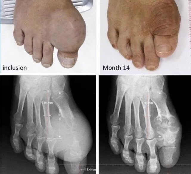 Phần khớp xương bị phá hủy có dấu hiệu dần phục hồi trên bệnh nhân gút nặng sau 14 tháng điều trị được công bố tại Hội thấp khớp học Mỹ 2020 (ACR).