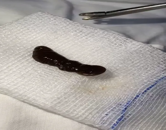 Dị vật con vắt lấy ra từ mũi của bé trai. Ảnh: BVCC Dị vật con vắt lấy ra từ mũi của bé trai. Ảnh: BVCC