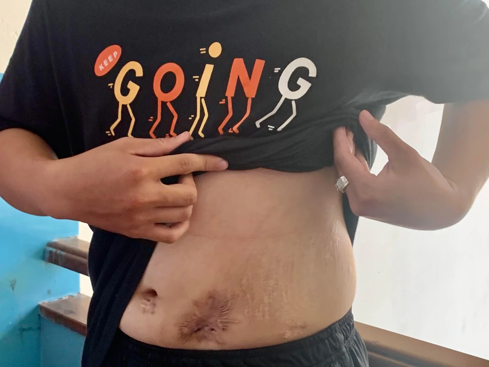 K. bị tai nạn với chằng chịt vết thương trên người, những tưởng sẽ suốt đời đeo túi nước tiểu bên mình. Ảnh: HL