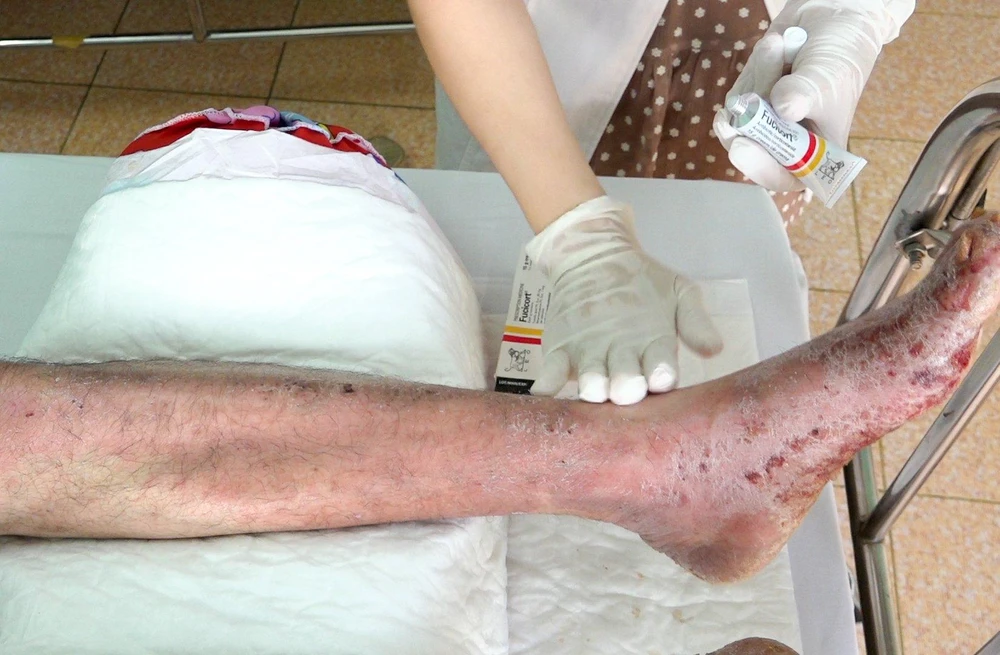 Bệnh nhân bị nhiễm trùng nặng do chích vỡ mụn nước được điều trị tại Bệnh viện Da liễu TP.HCM. Ảnh: BVCC