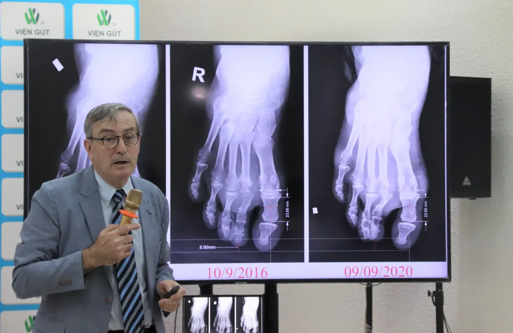GS Thomas Bardin trình bày tại hội thảo. Ảnh: HL Mô hình điều trị bệnh gút