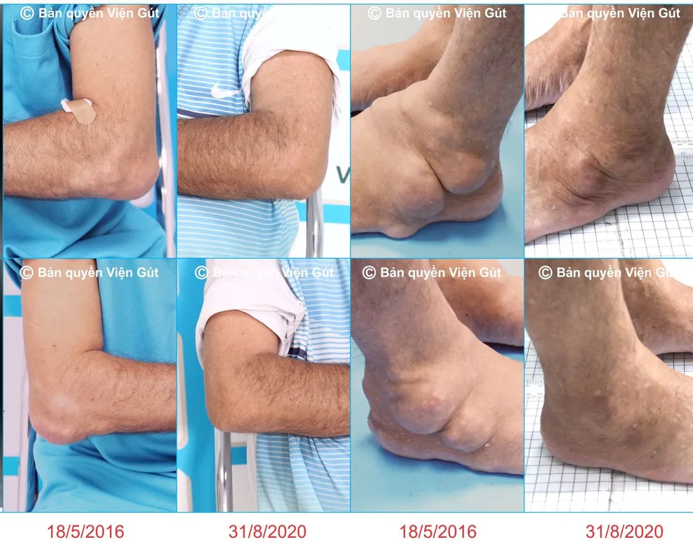 Các hạt tophi nhỏ dần rõ rệt ở bệnh nhân điều trị ngoại trú ở Viện Gút. Ảnh: VGCC Mô hình điều trị bệnh gút