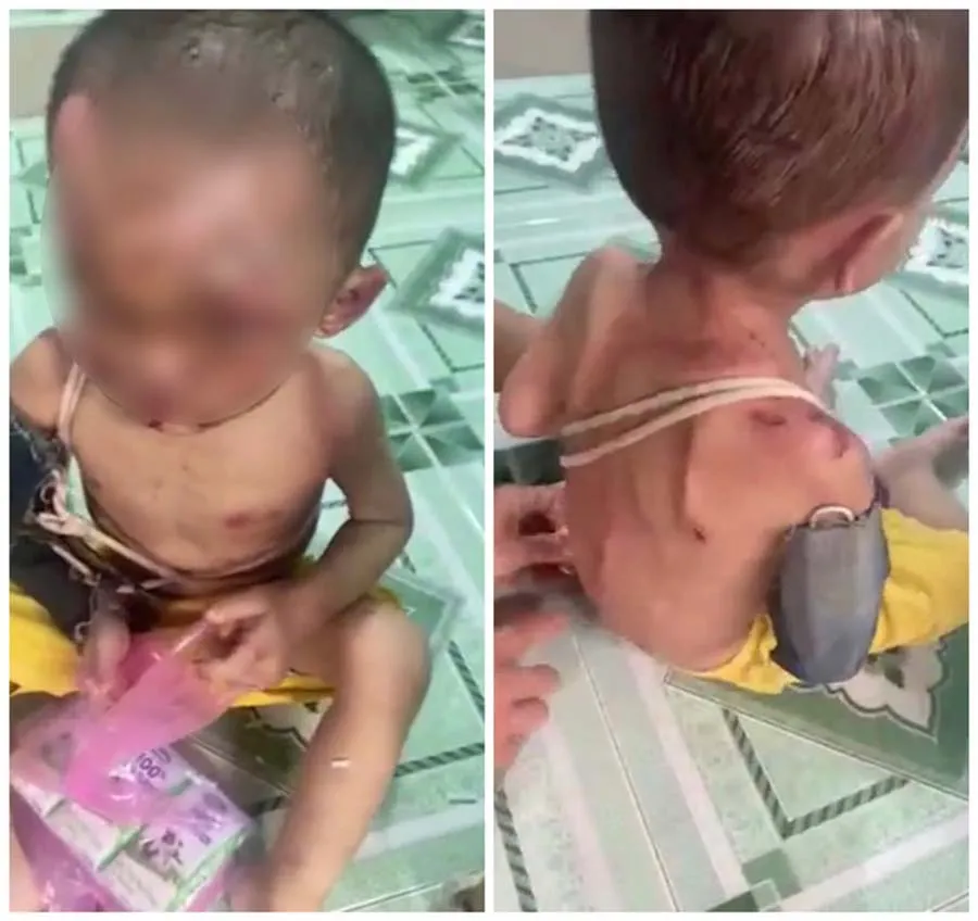 Bé trai với nhiều vết thương trên người. (Ảnh cắt từ clip)