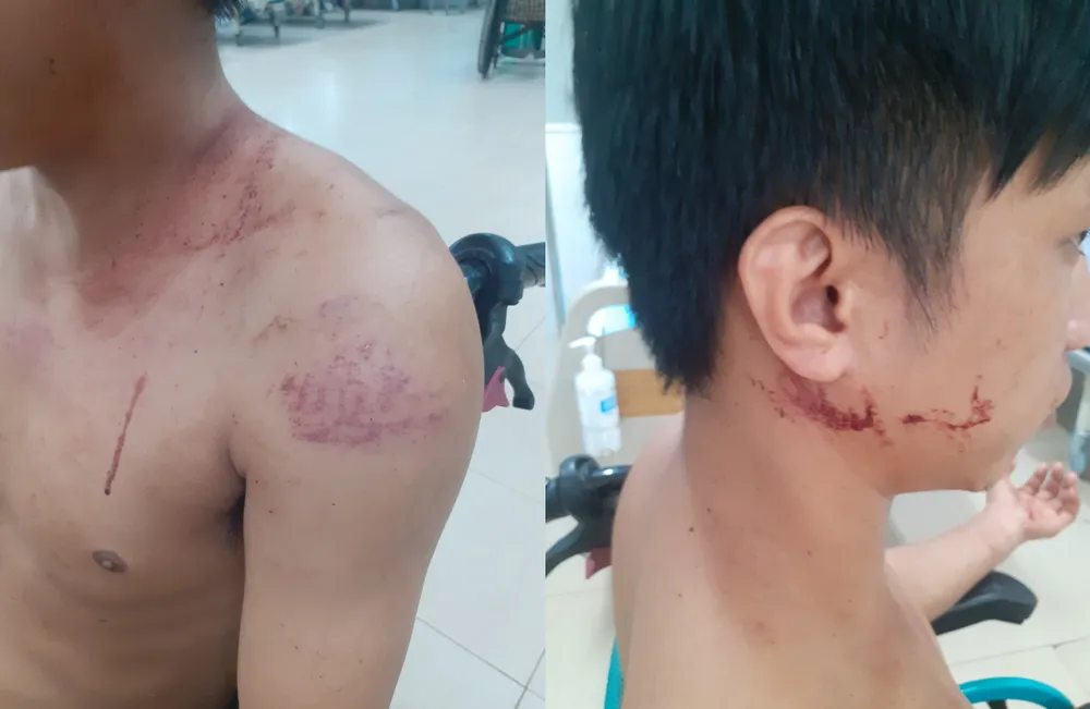 Anh H đang được điều trị tại bệnh viện với nhiều vết thương trên người. Ảnh: LA