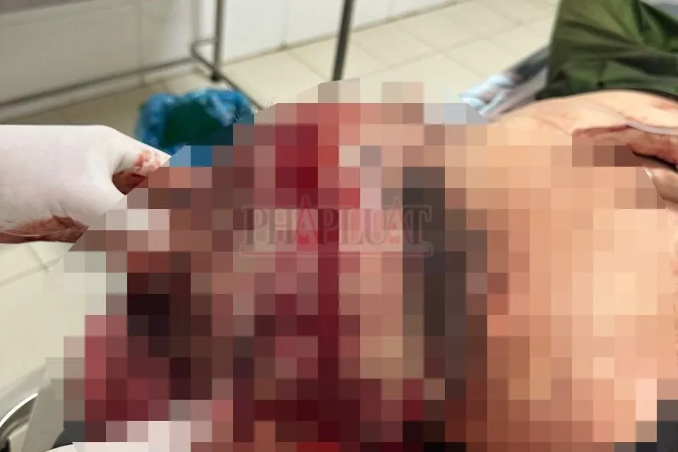 Hiện đại úy công an bị chém đang được cấp cứu tại bệnh viện Chợ Rẫy. Ảnh: LA đại úy công an.jpg