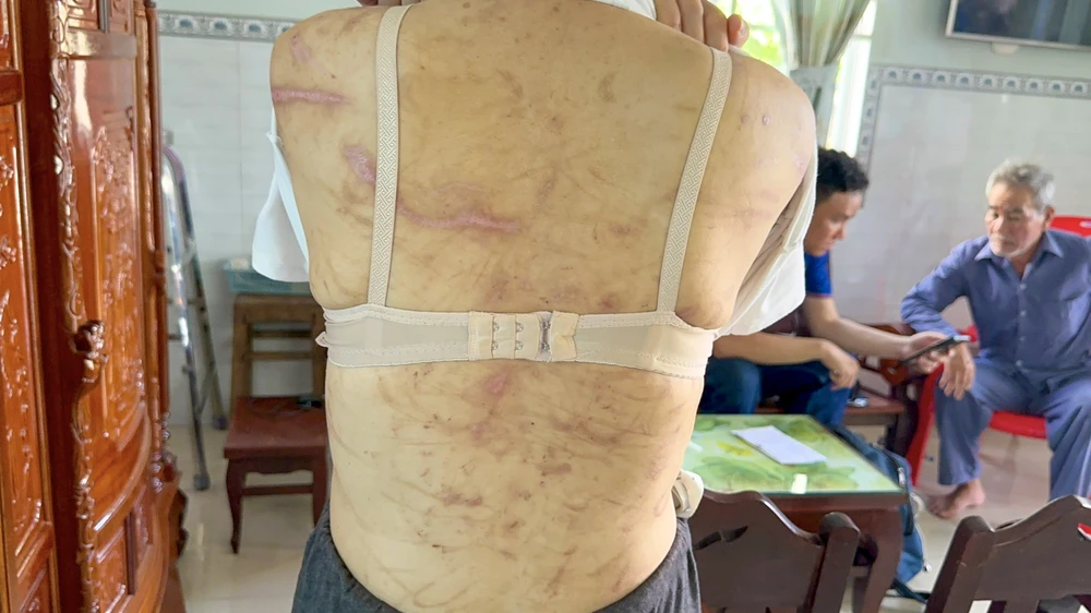 Những đòn roi còn hằn trên lưng chị G. Ảnh: AH.