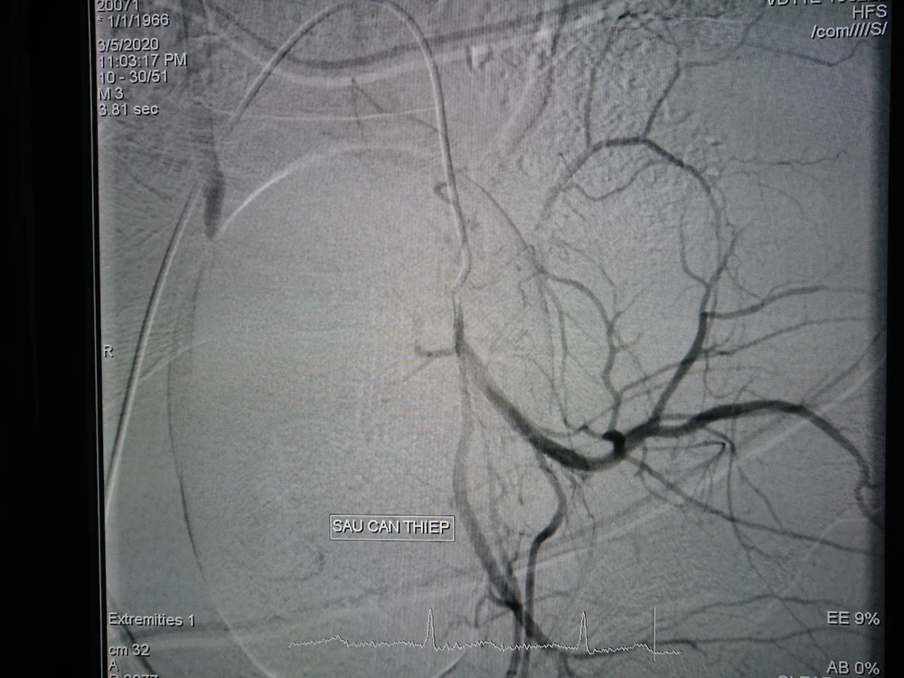 Hình ảnh trước và sau can thiệp nút mạch 2