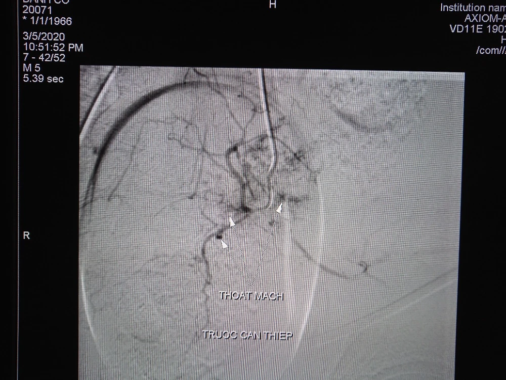 Hình ảnh trước và sau can thiệp nút mạch 1