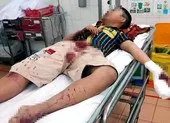 Dùng bột diêm để chế pháo, thiếu niên bị thương