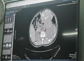 Chạy chơi trên bờ ruộng, bé 9 tuổi bị té phải cắt bỏ lá lách ảnh 1 Hết hồn vì khám sức khỏe ra 3 khối u 2,4 kg trong bụng
