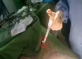 Trộm chó, thanh niên bị bắn suýt chết ảnh 2 Nam thanh niên bị đạn bắn xuyên bụng phải cắt thận