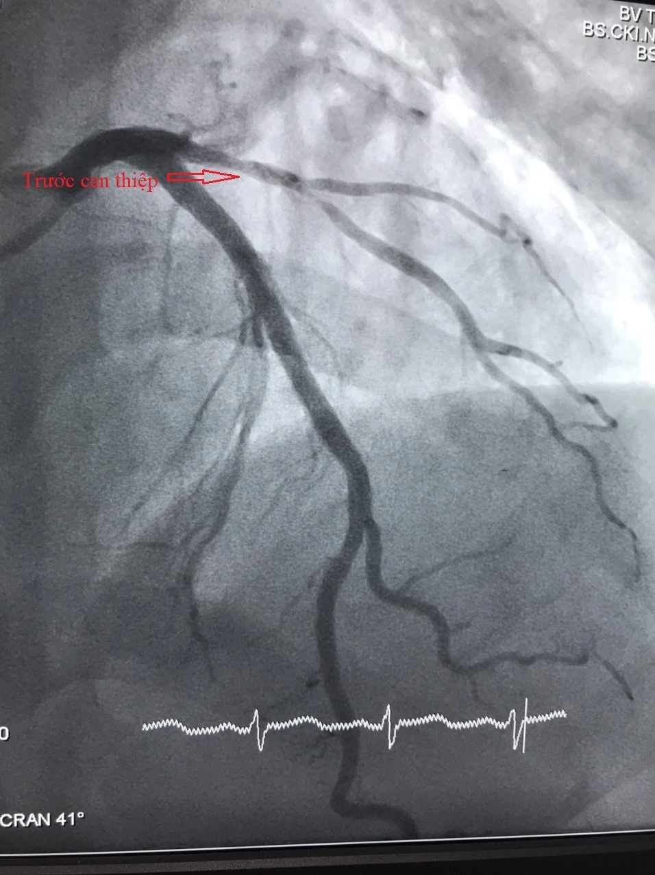 Hình ảnh tổn thương mạch vành trước và sau can thiệp. Ảnh: BVCC 1