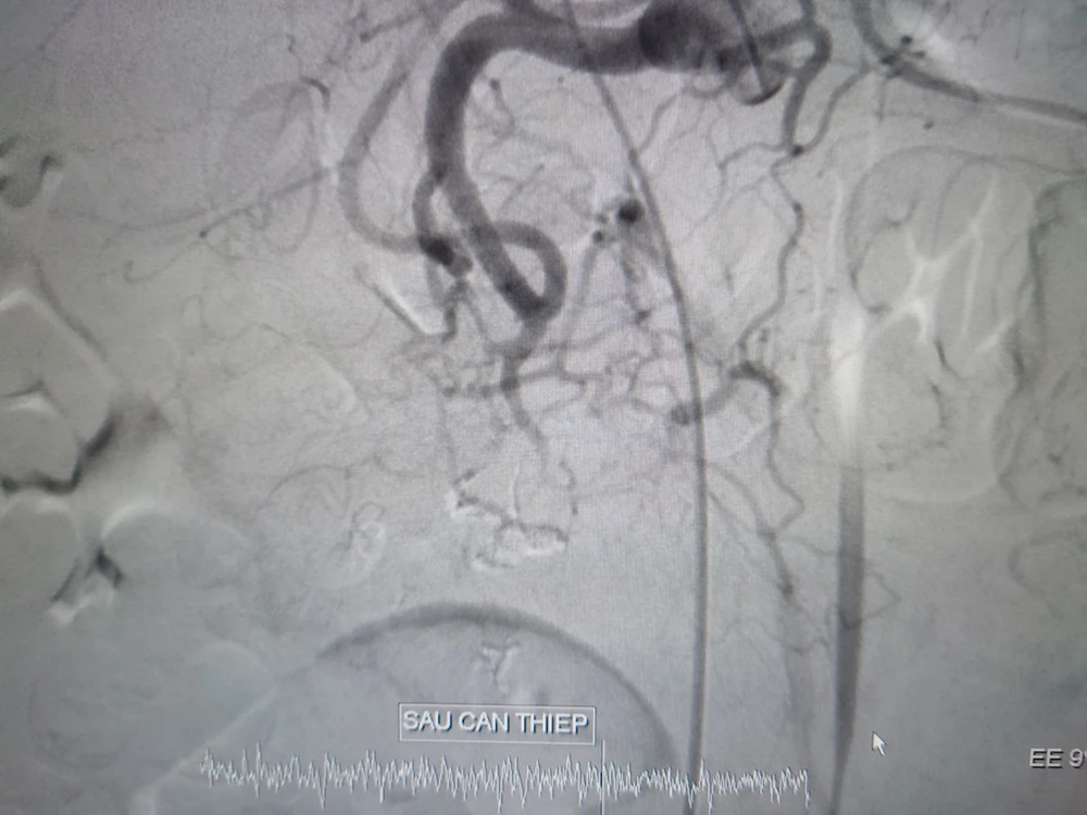 Động mạch vị tá tràng trước và khi can thiệp. Ảnh: BVCC 2