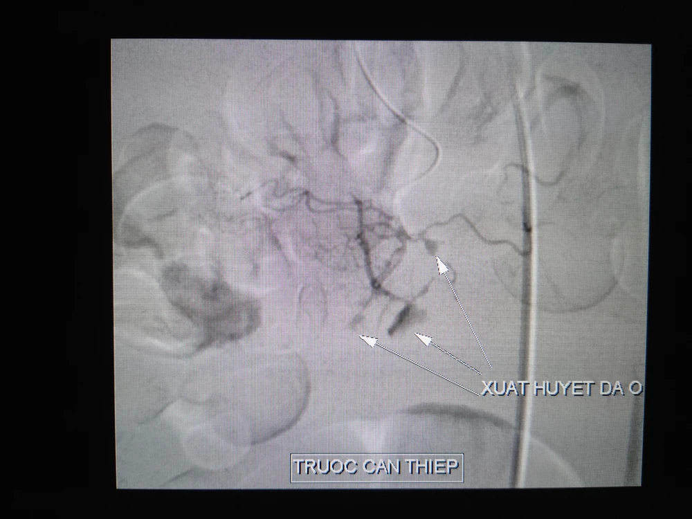 Động mạch vị tá tràng trước và khi can thiệp. Ảnh: BVCC 1