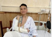 Trầm cảm thời gian dài, cụ ông 70 tuổi tự đóng đinh vào đầu ảnh 2 Khắc Việt đã được mổ đóng đinh, đang tạm dừng hoạt động