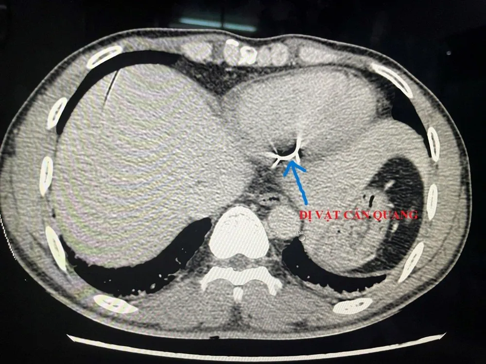 Hình ảnh chụp cắt lớp phát hiện dị vật trong tim bệnh nhân. Ảnh: BVCC