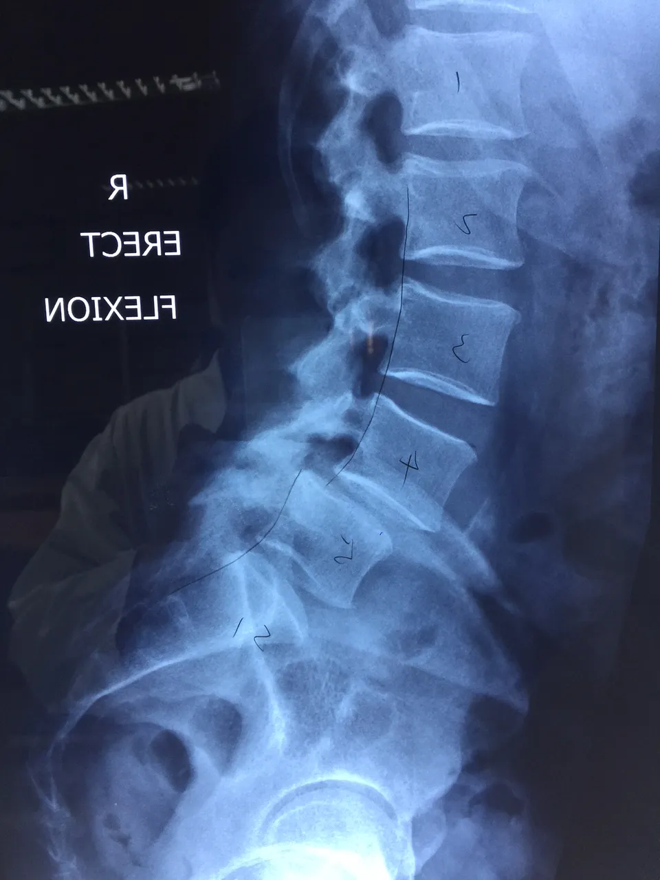 Phẫu thuật cột sống cho bệnh nhân nước ngoài ảnh 1