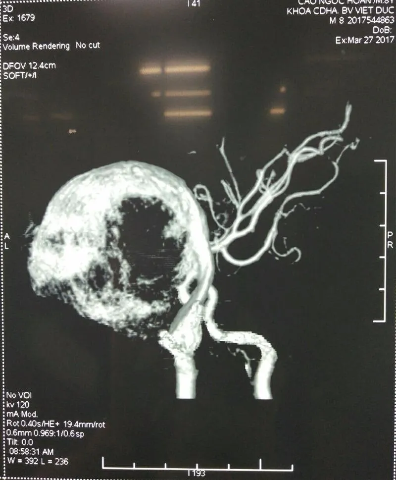 Hình ảnh phình động mạch cảnh trong khổng lồ của bệnh nhân.