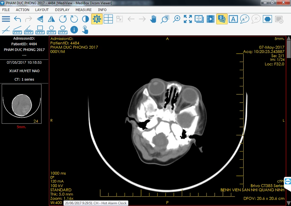 Phẫu thuật ghép sọ não cho bé trai 37 ngày tuổi ảnh 2