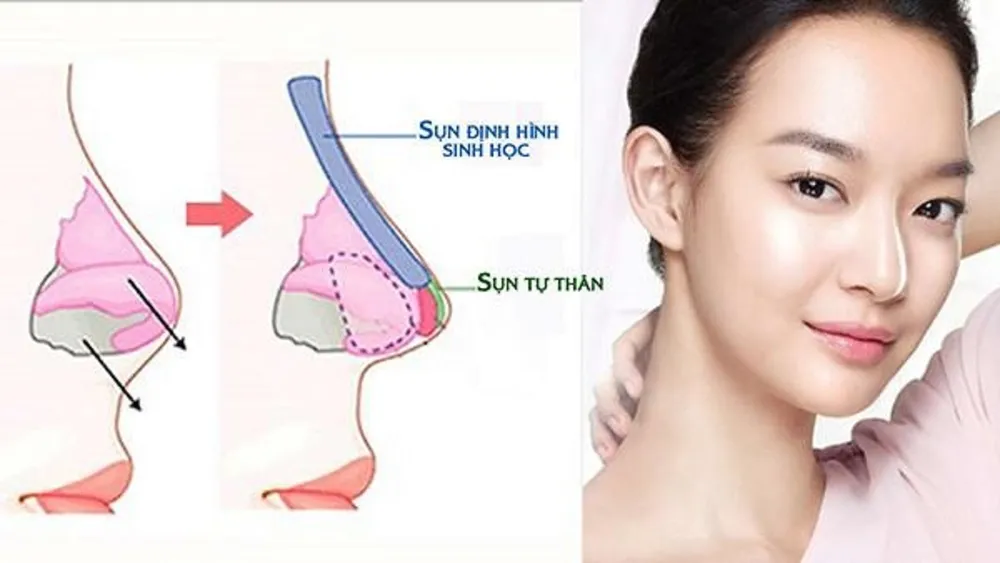 Nâng mũi S line kết hợp cả sụn tự thân và sụn nhân tạo khi thẩm mỹ