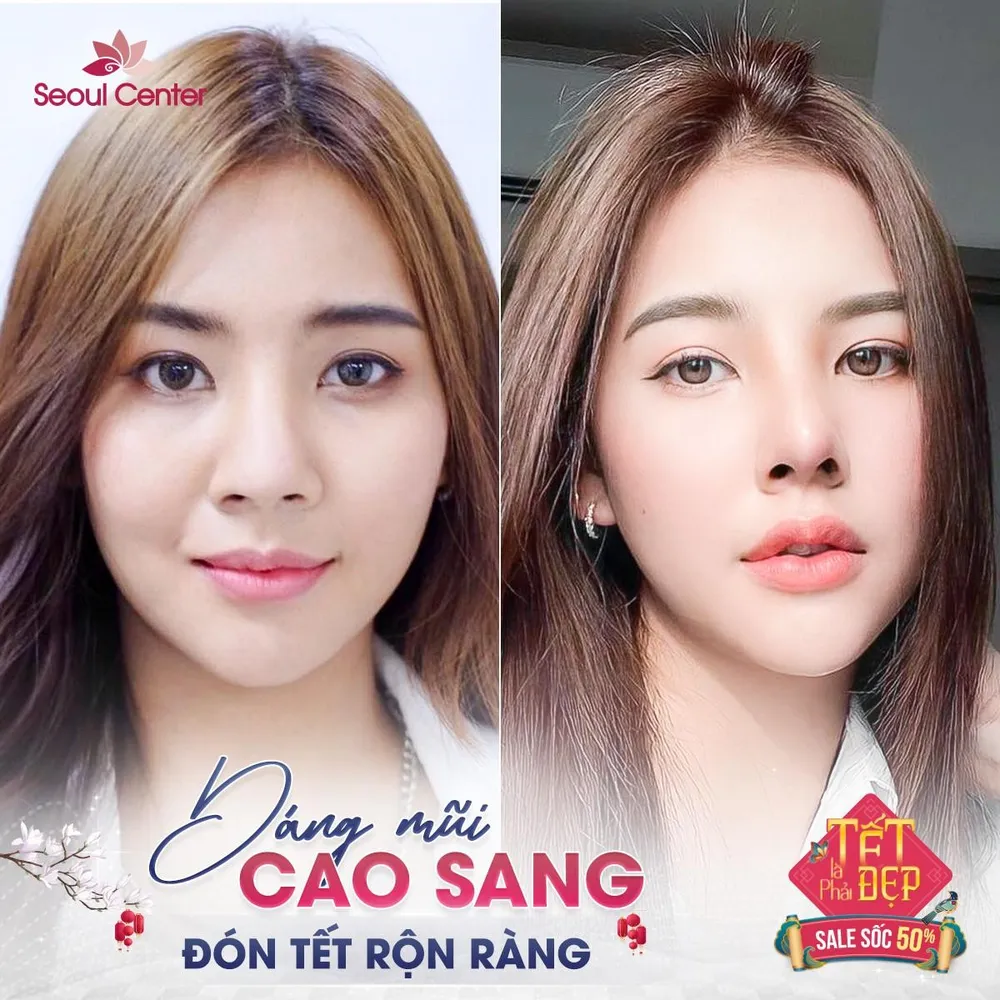 Nâng mũi S line giúp dáng mũi cao cân đối với hiệu quả trọn đời