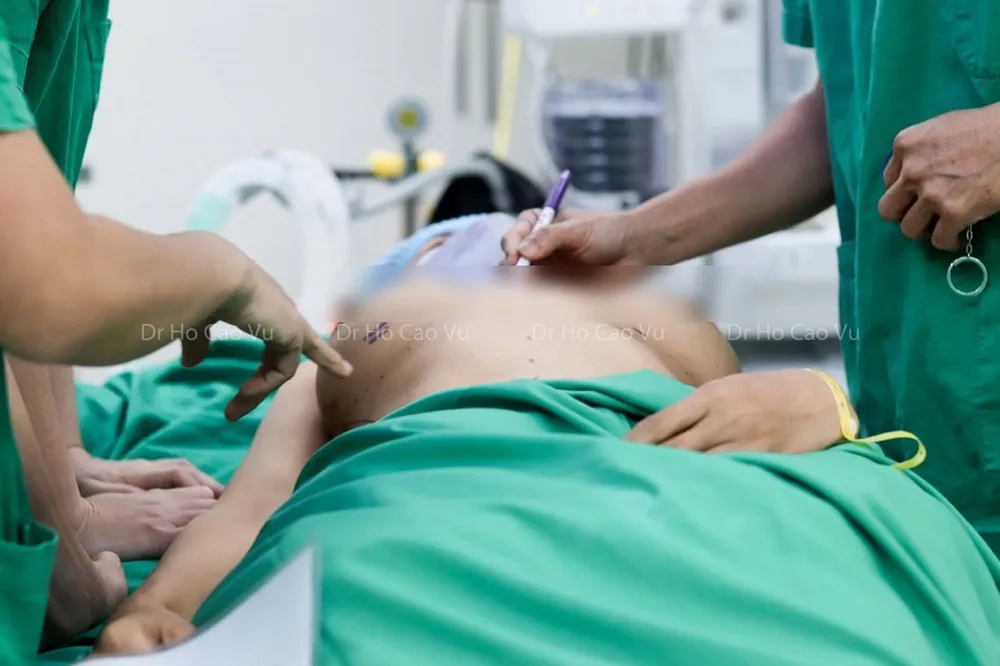 Bác sĩ đo vẽ trước phẫu thuật tháo túi ngực, chỉnh ngực bị thông khe