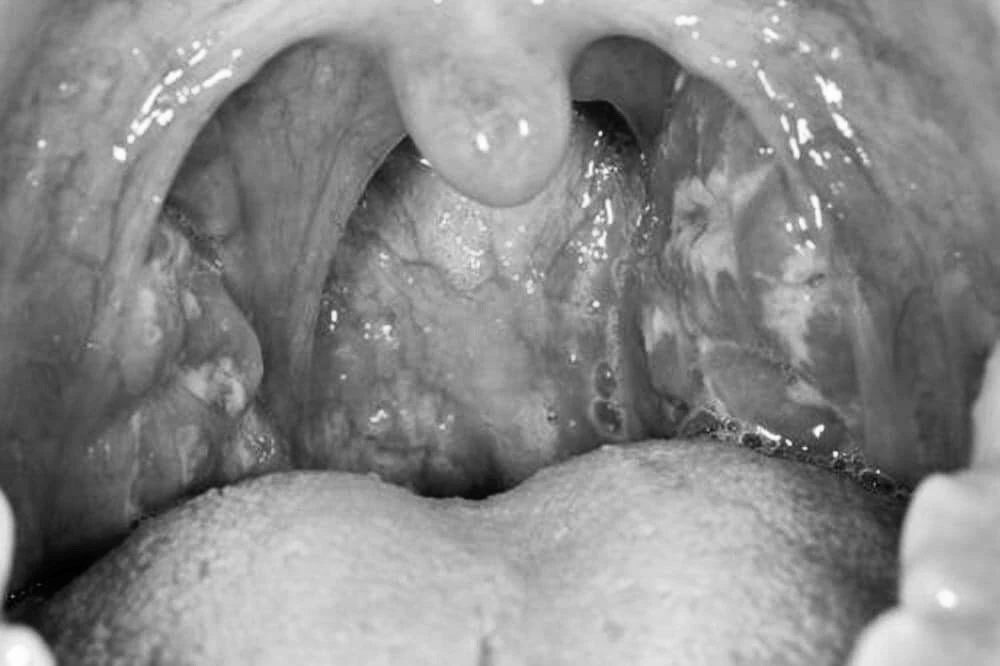 Tình trạng cổ họng bị viêm. Ảnh: BSCC Viêm họng.jpg