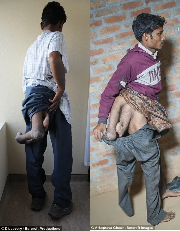 chàng trai ấn độ có 4 chân